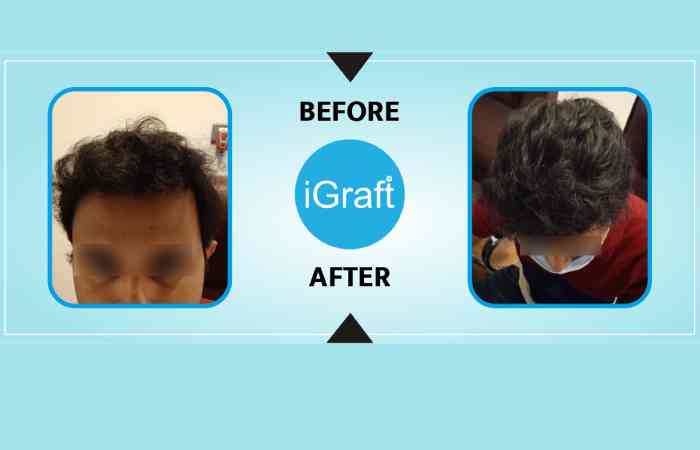 Igraft Best Hair Transplant Vijayawada and Skin Treatments